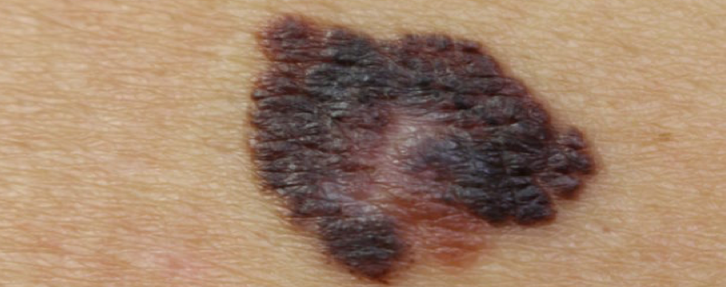 Najčešći tipovi malignih tumora kože i kako ih lečiti - BT Surgery