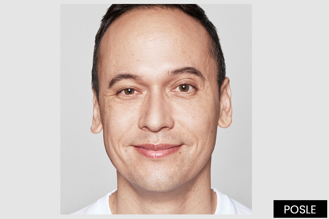 Popunjavanje bora sa RESTYLANE® i Restylane® REFYNE™ 