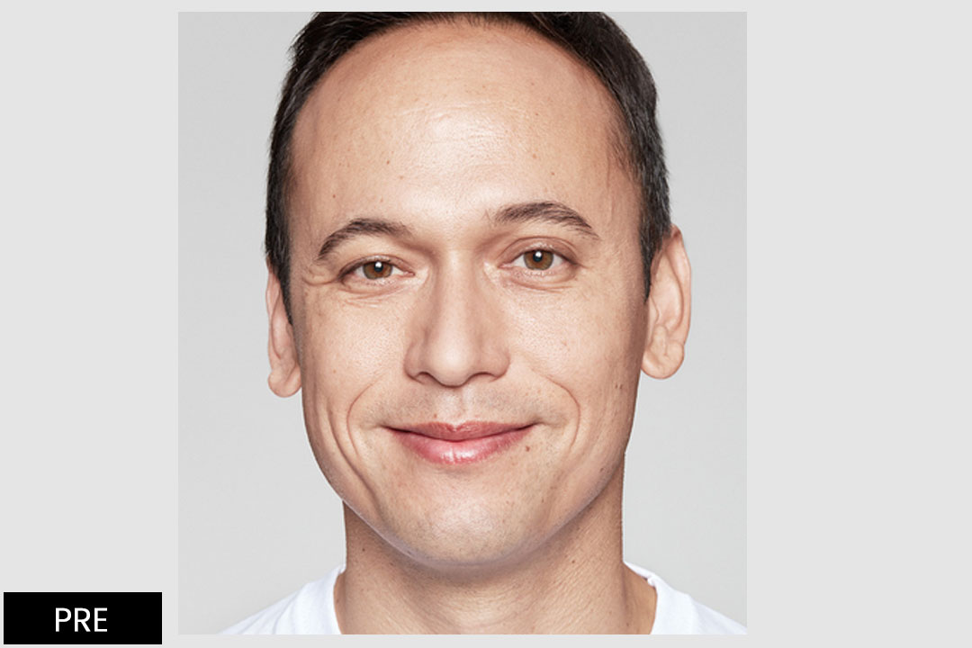 Popunjavanje bora sa RESTYLANE® i Restylane® REFYNE™ 