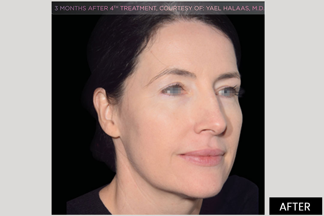 EMFACE - non-surgical lifting | Posle