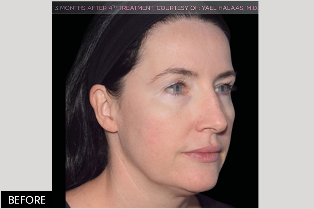 EMFACE - non-surgical lifting | Pre