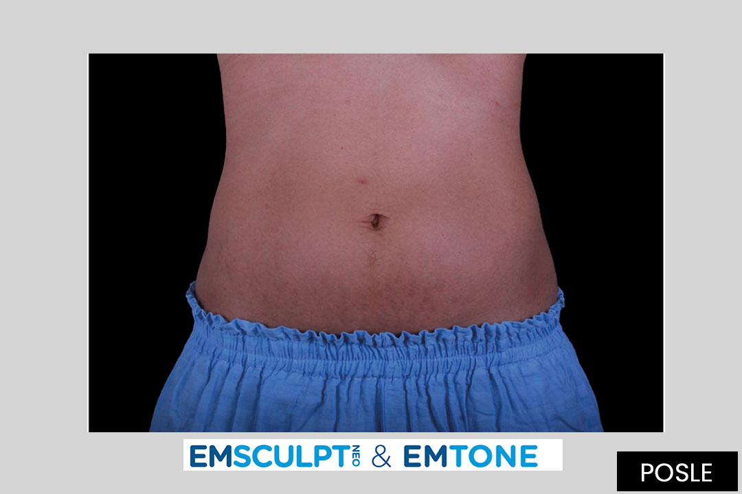 EMTONE and EMSCULPT - 12 months after treatment
