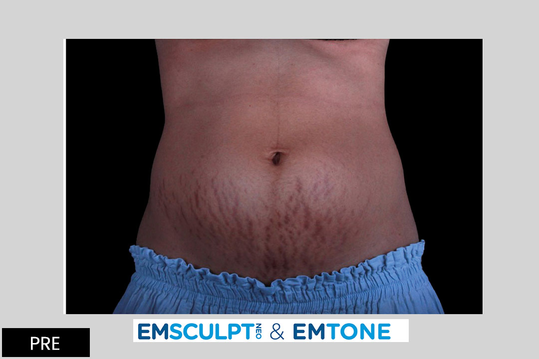 EMTONE and EMSCULPT - 12 months after treatment