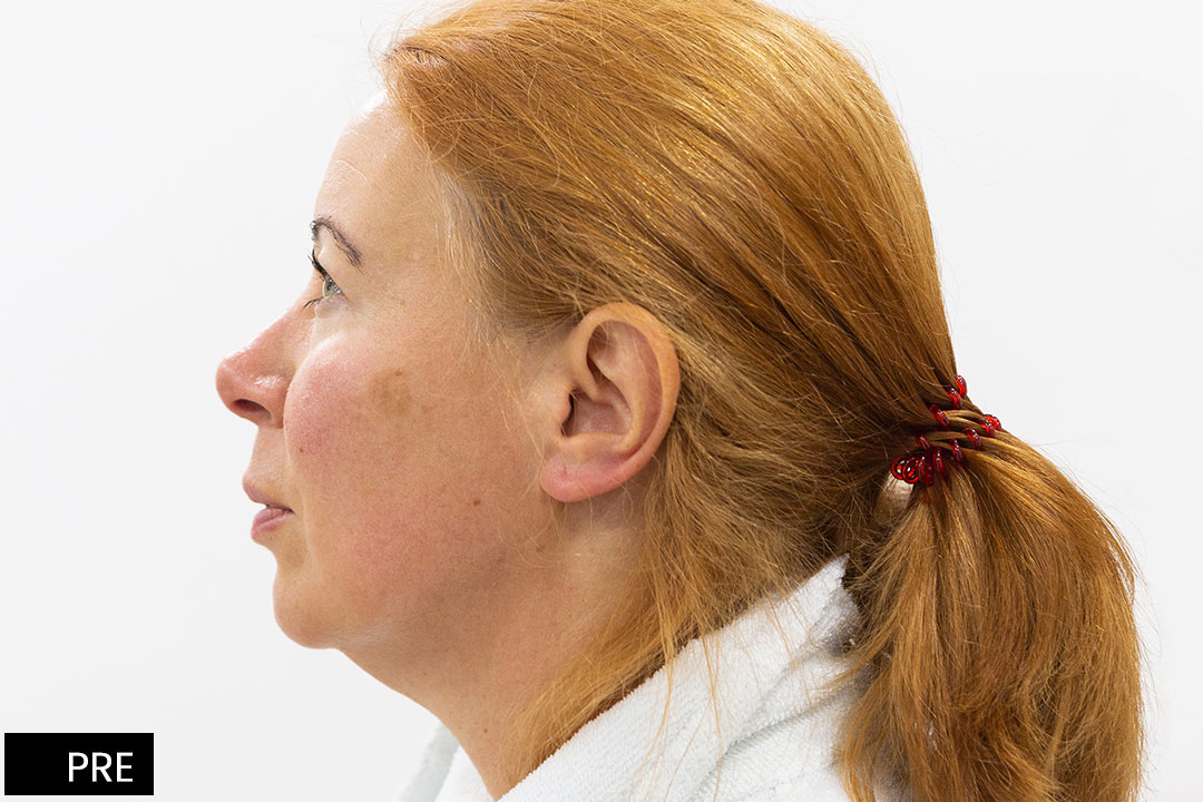 Lifting of the chin line and cheekbones- ©BT Aesthetic Surgery Center