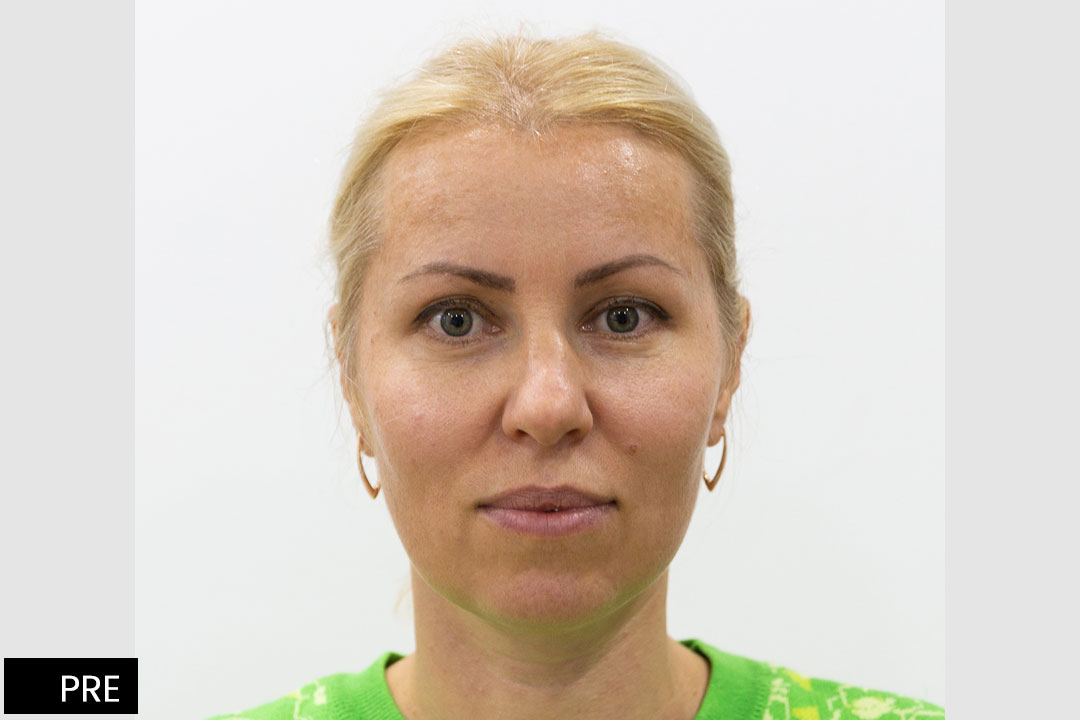 Eyebrow and nose lift - ©BT Aesthetic Surgery Center
