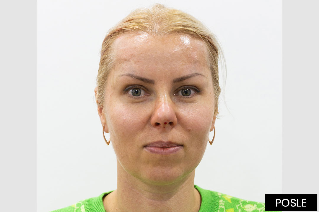 Eyebrow and nose lift - ©BT Aesthetic Surgery Center