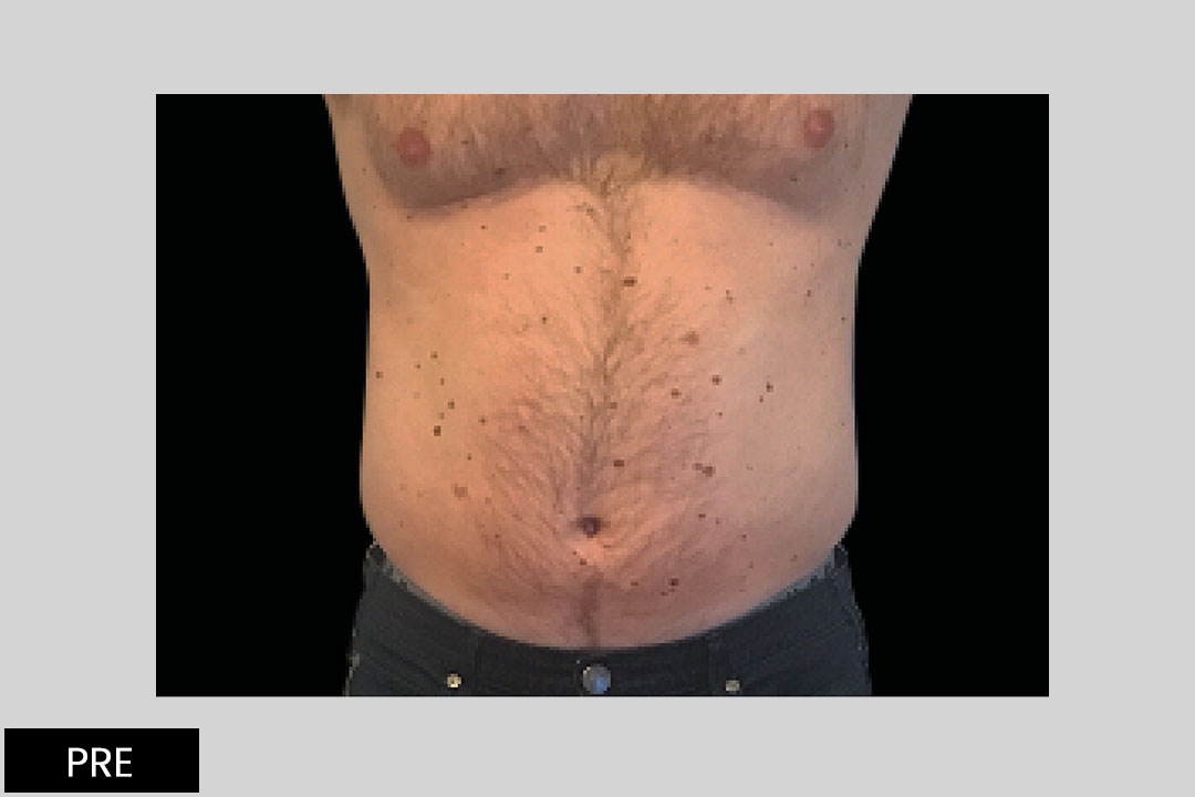 4 weeks after 4th treatment