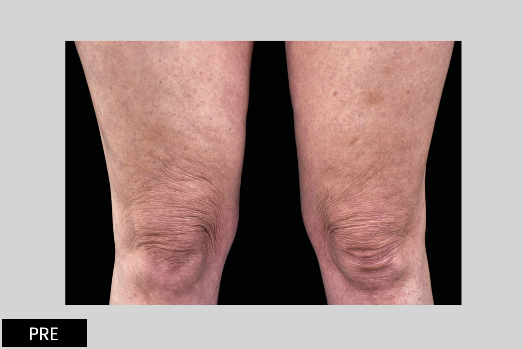 EMTONE- 3 months after 4th treatment