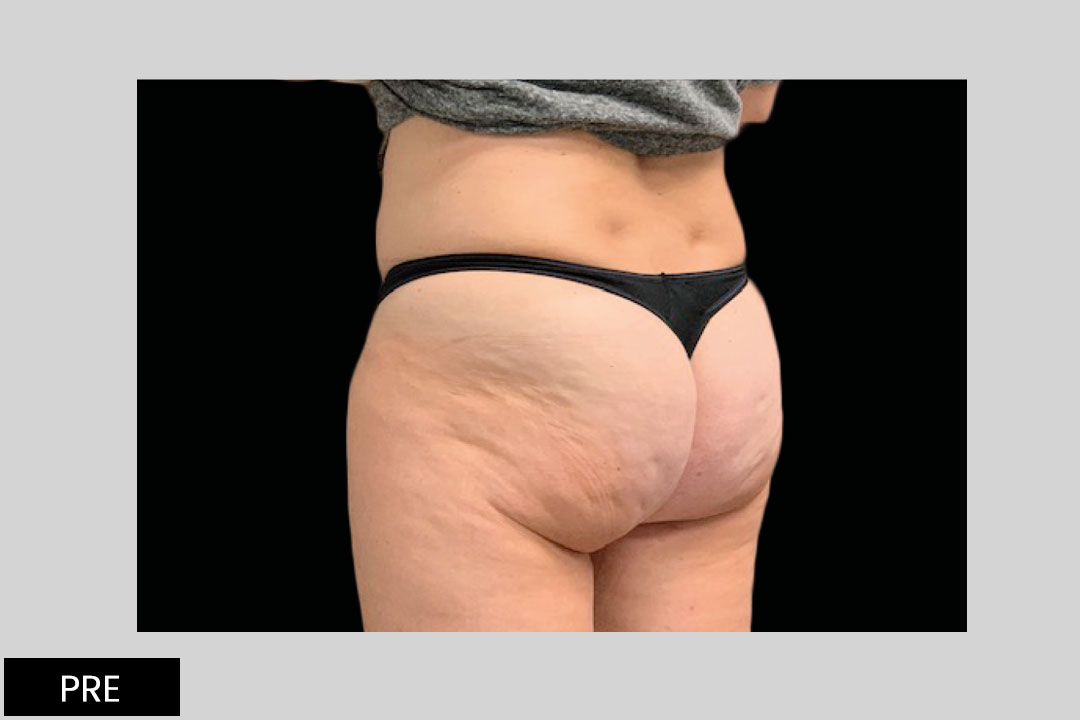 EMTONE- 6 weeks after tretment
