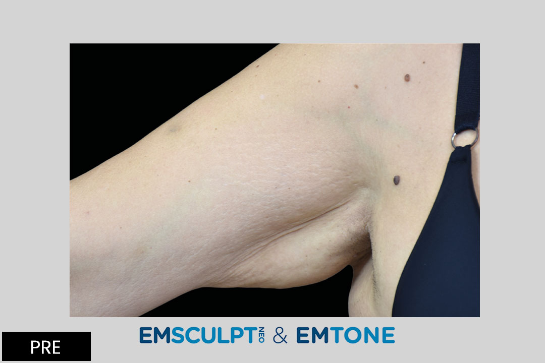 EMTONE and  EMSCULPT - 3 months after 4th treatment