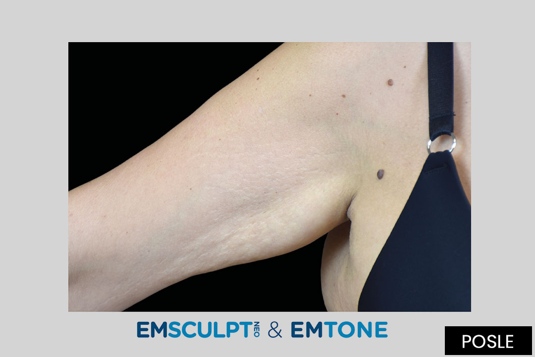 EMTONE and  EMSCULPT - 3 months after 4th treatment
