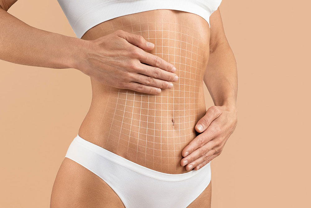 LipoLife- Laserska liposukcija