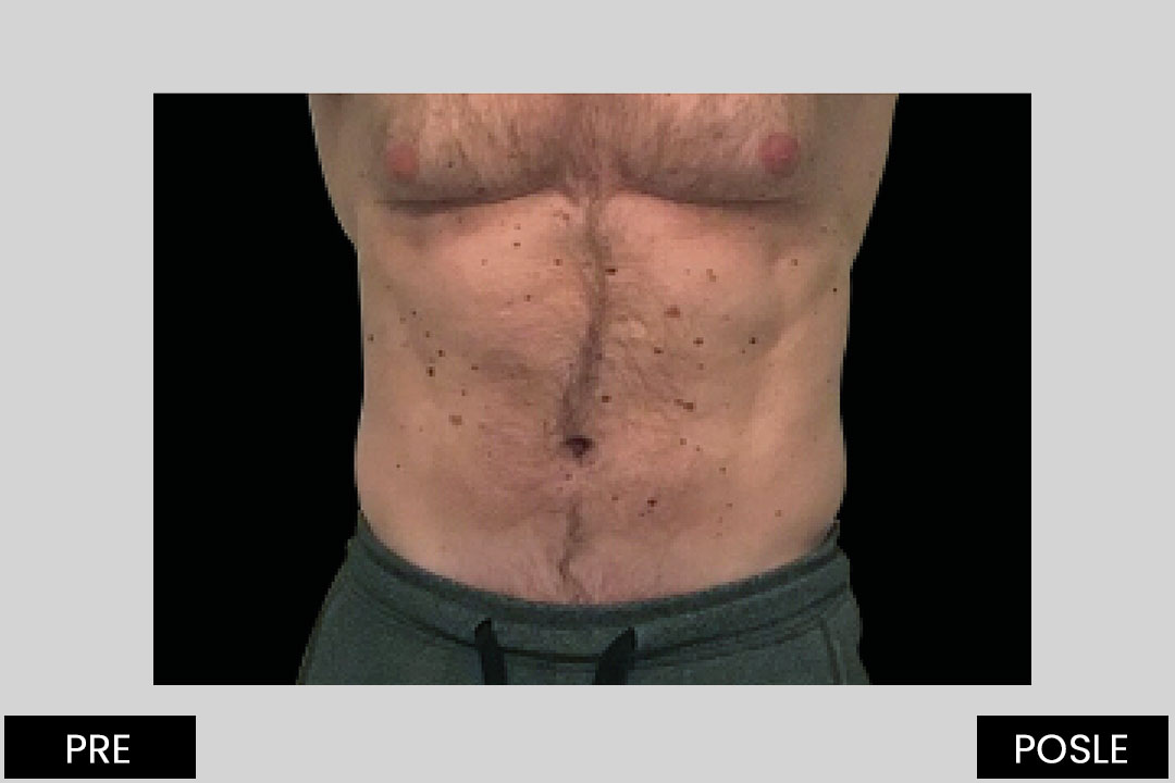 4 weeks after 4th treatment