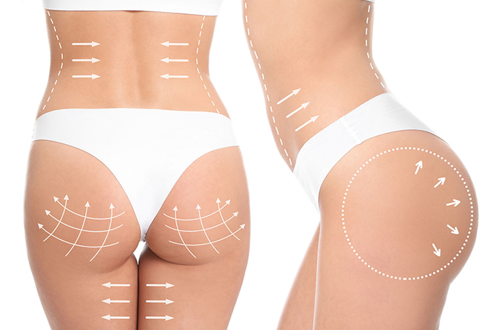 Buttocks Lipofilling and Lipomodelling