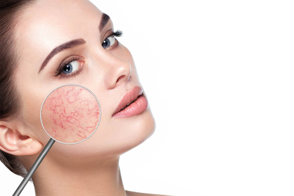 Removal Of Dilated Capillaries