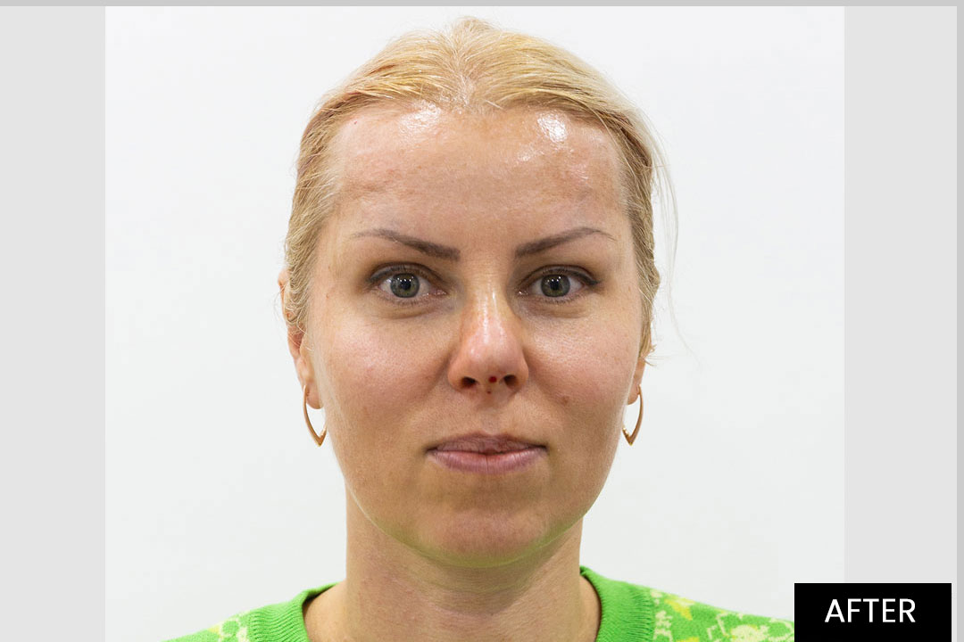 Aptos Thread Lifting-Eyebrow and nose lifting | Posle