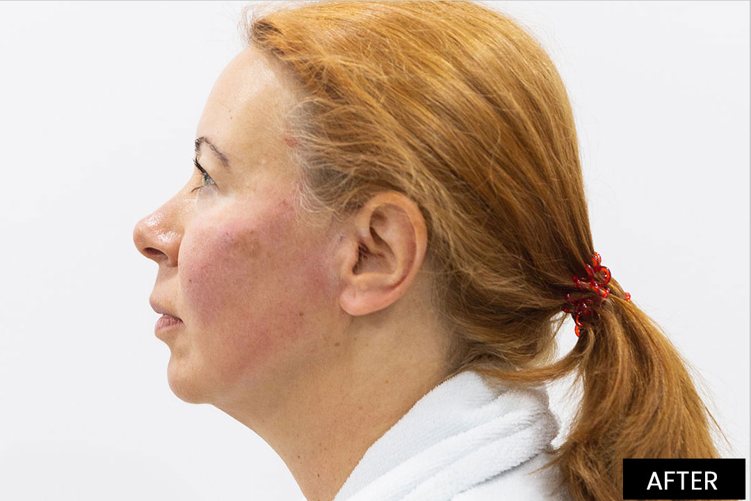 Aptos Thread Lifting - Lifting of cheekbones and chin line | Posle
