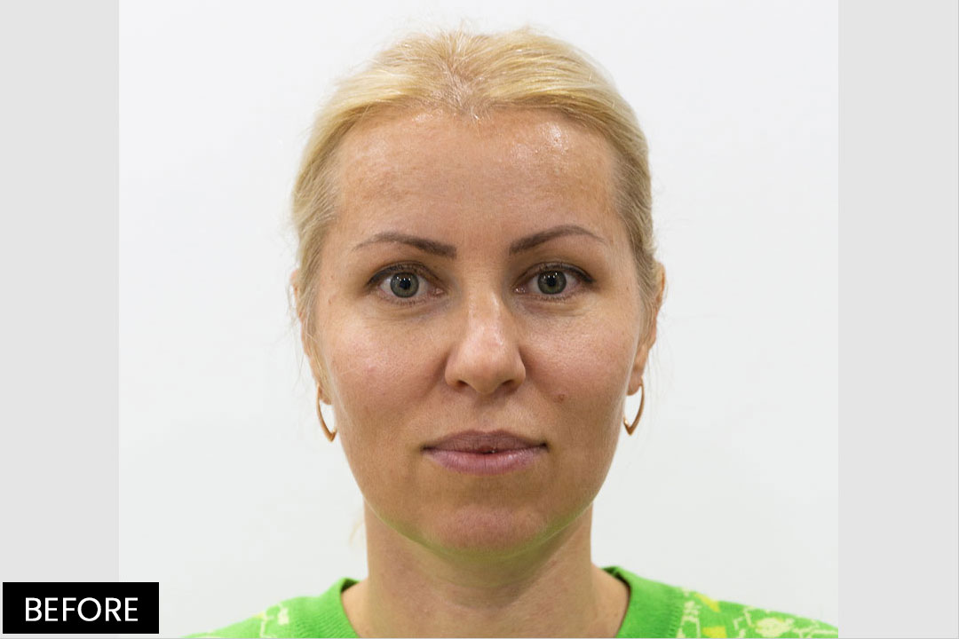 Aptos Thread Lifting-Eyebrow and nose lifting | Pre