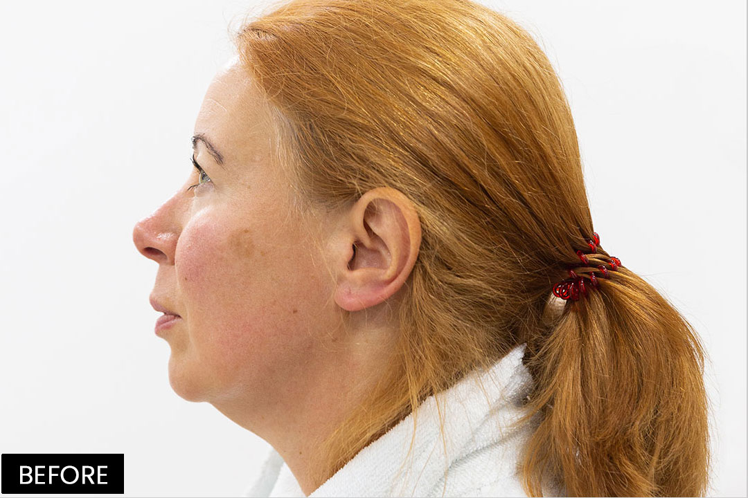 Aptos Thread Lifting - Lifting of cheekbones and chin line | Pre