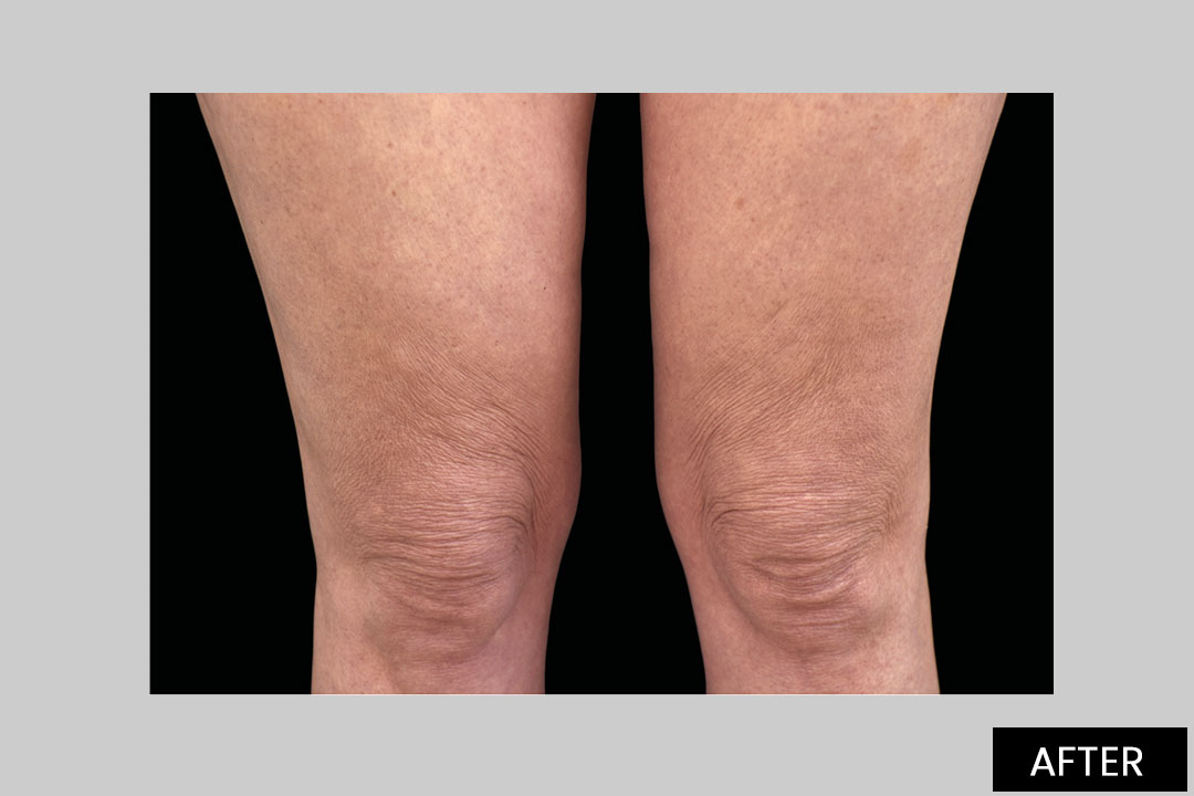 EMTONE-knees | Posle