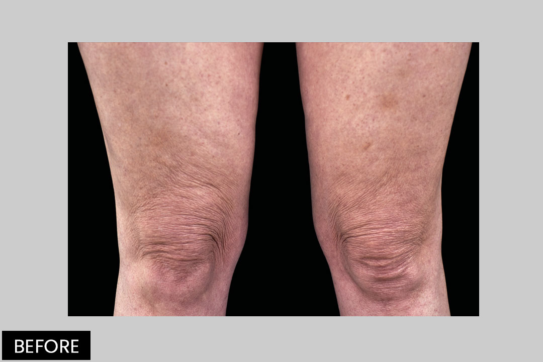 EMTONE-knees | Pre