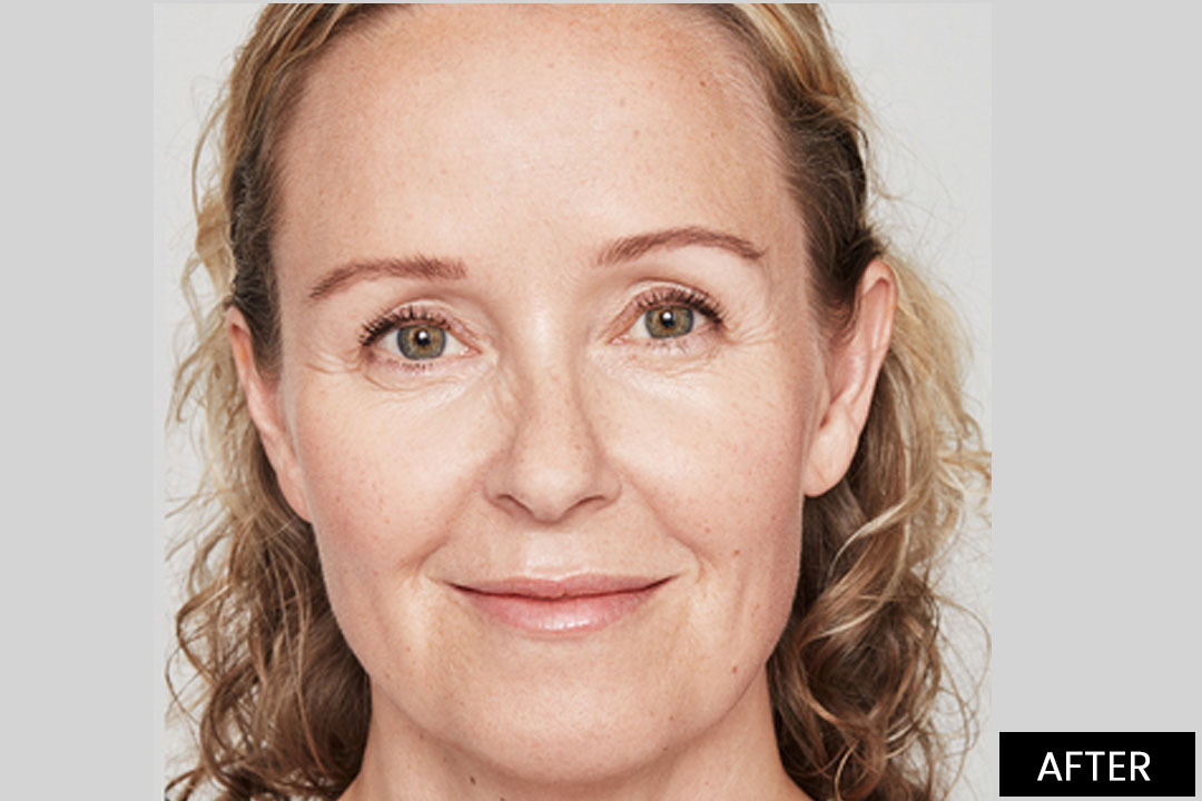 Hyaluronic injections - Lifting the volume of the face and lips with Restylane® | Posle