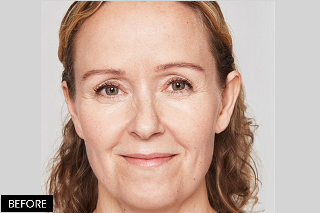 Hyaluronic injections - Lifting the volume of the face and lips with Restylane® | Pre